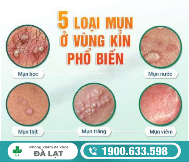 MỌC MỤN NƯỚC Ở VÙNG KÍN NAM GIỚI 
